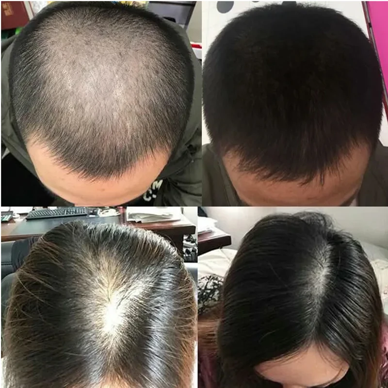오버로드 식물성 모발 성장액 탈모 방지 및 모근 고정  - Hair Care Or Haircare 리뷰 및 가격