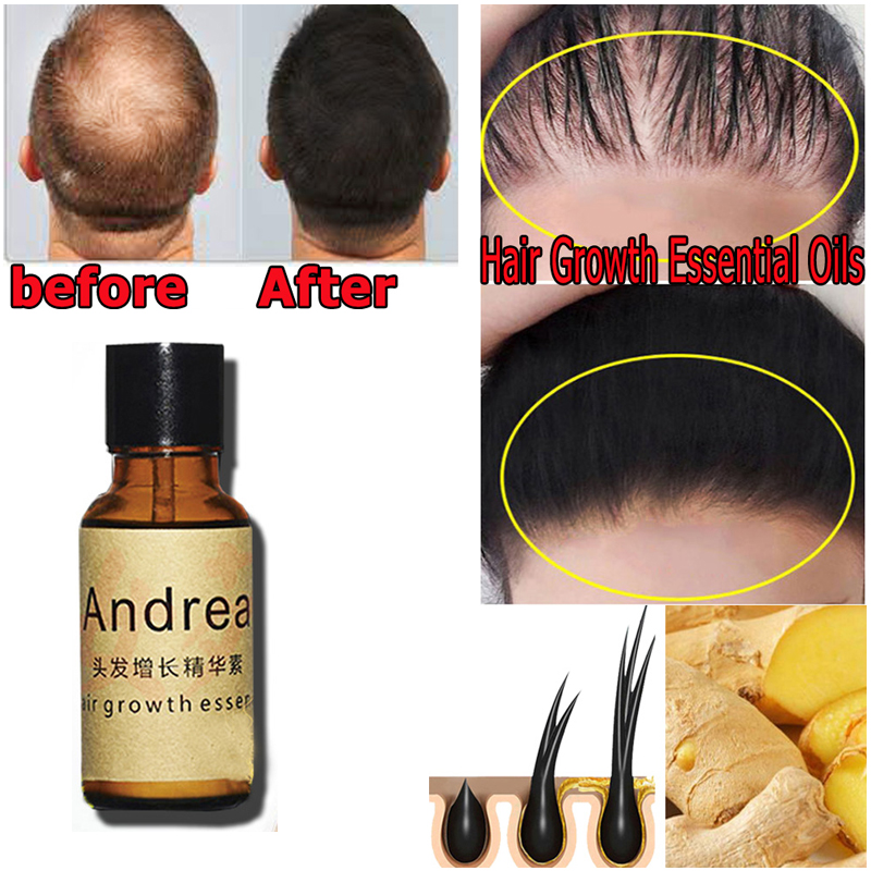 2/5/10Pcs 안드레아 모발 성장 세럼 오일 허벌  - Hair Care Herbal 리뷰 및 가격